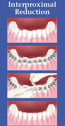 Interproximal Reduction