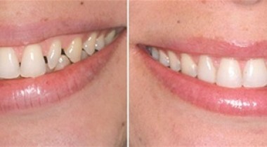 Equilibrio de dientes y huesos maxilares
